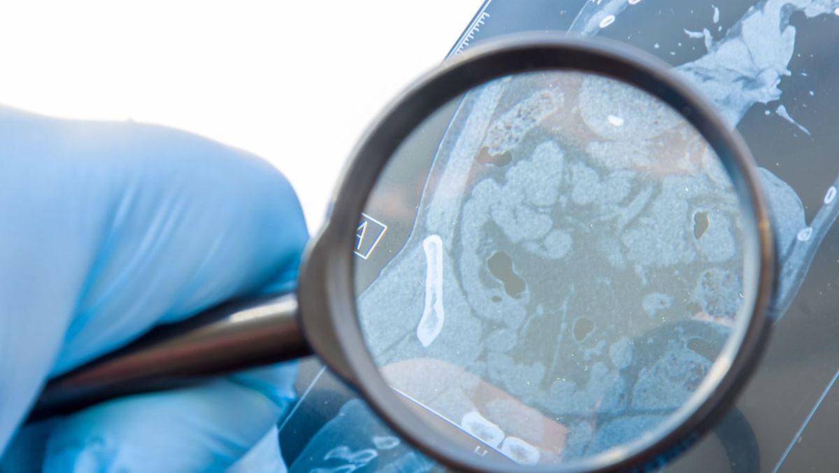 În R. Moldova vor putea fi diagnosticate încă 30 de boli rare. Mai mulți pacienți vor primi tratamente gratuite