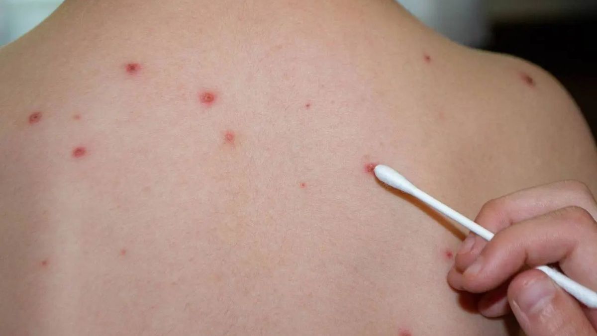 Un copil din capitală a fost diagnosticat cu rujeolă. Familia revenise recent de la munte din Ucraina